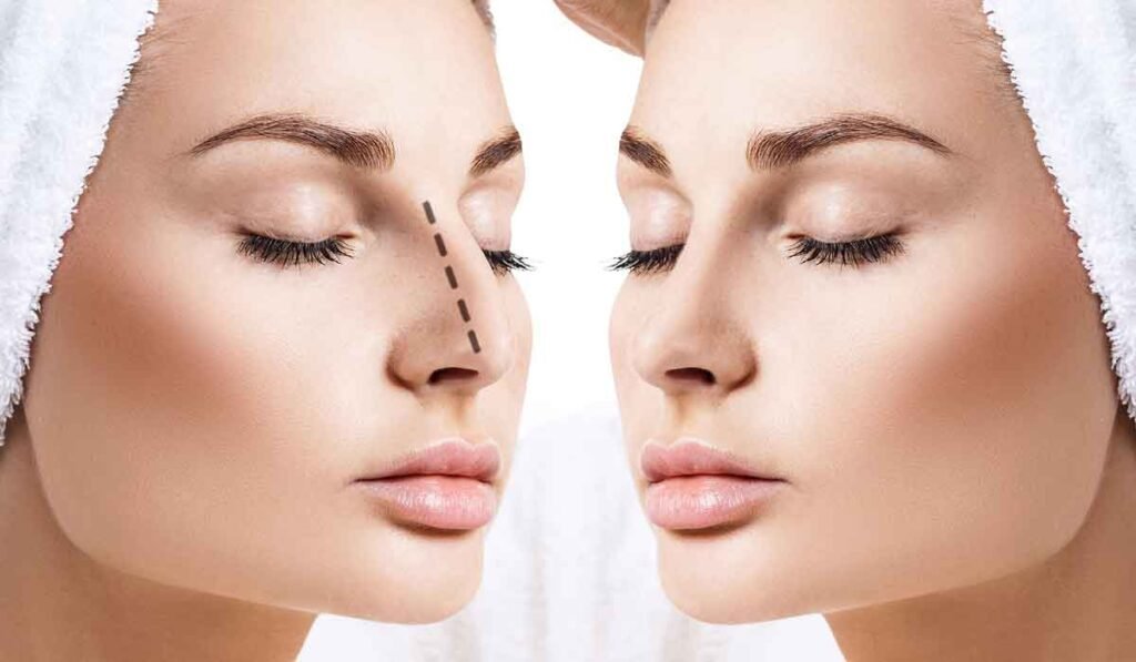 Rhinoplasty