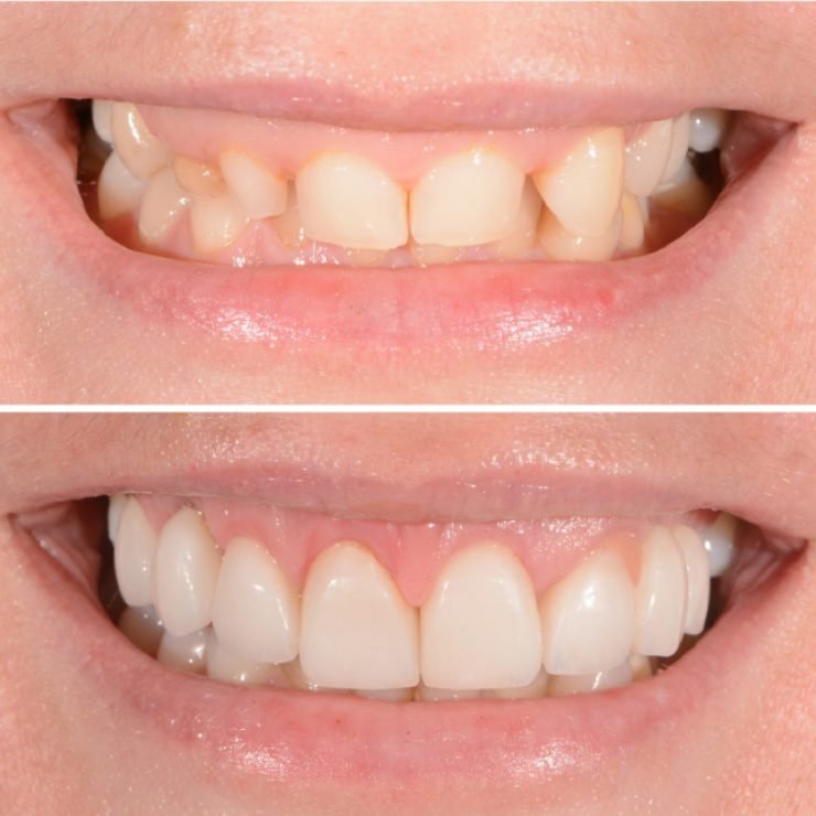 الأسنان القصيرة: الأسباب والحلول التجميلية