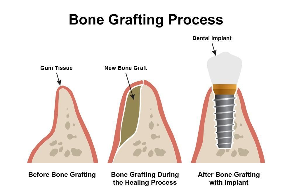 Bone Grafting Before Implants: Is It Always Necessary?