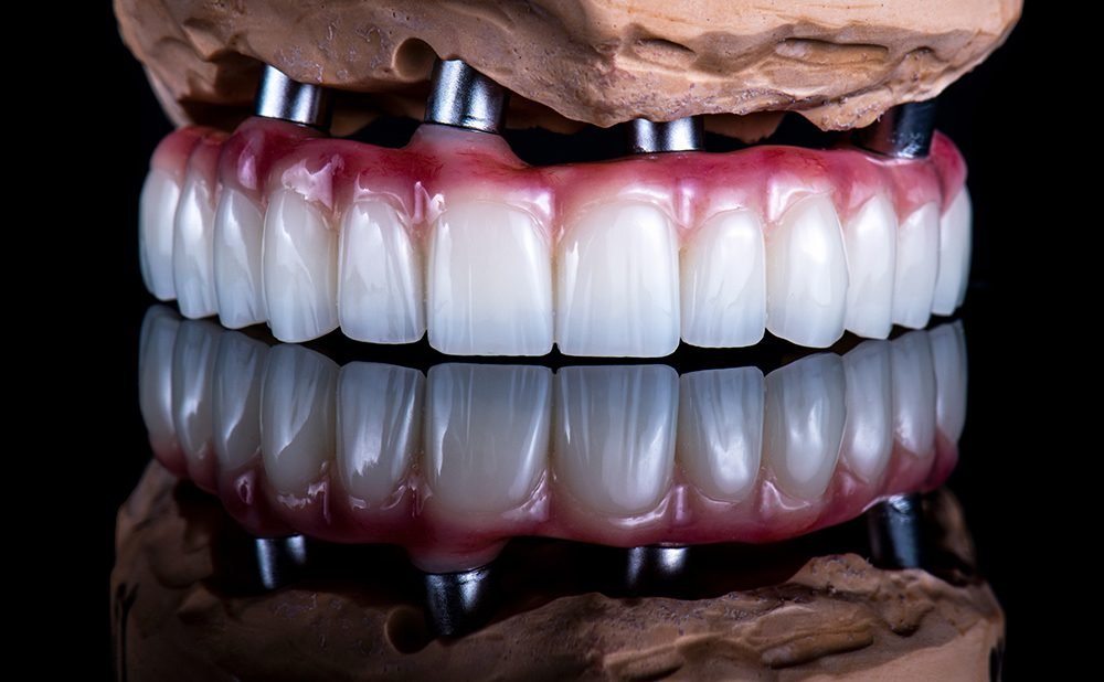 Titanium vs Zirconia Dental Implants: Which One Is Truly Better in 2026?