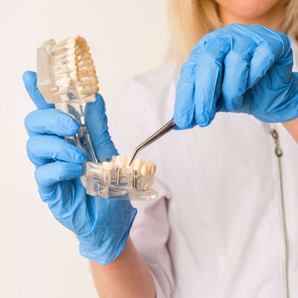 How to Care for Your Dental Implant After Implant Surgery?